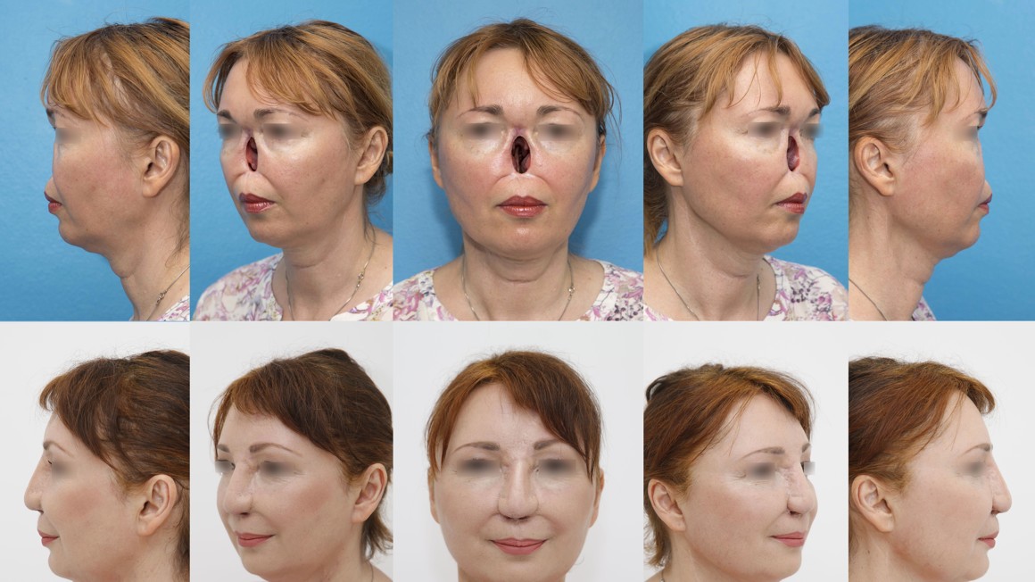 web3-slovenia-surgeons-success-nose-operation